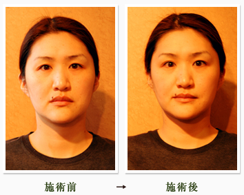 施術前と施術後の比較　整顔　整体　リフレクソロジー